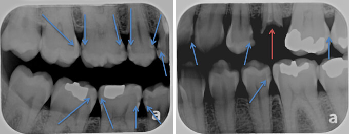 What Do Cavities Look Like On X Ray