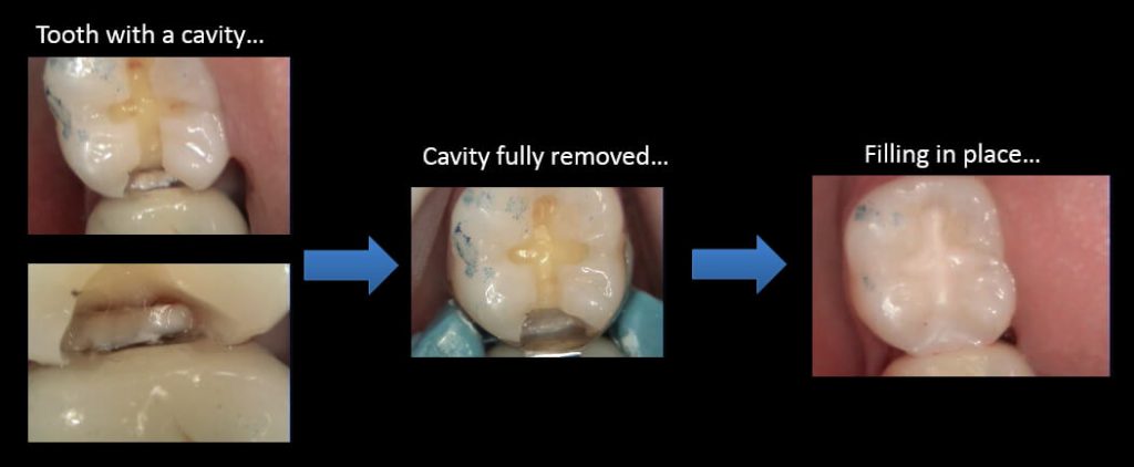 what-does-a-cavity-look-like-mint-hill-dentistry