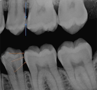 What Does a Cavity Look Like? | Mint Hill Dentistry