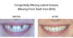 Congenitally Missing Lateral Incisors