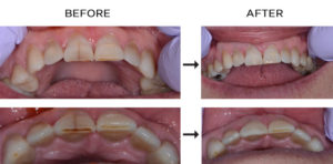 Craze lines before and after