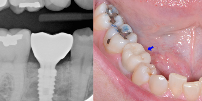 Fractured Adult Baby Tooth After