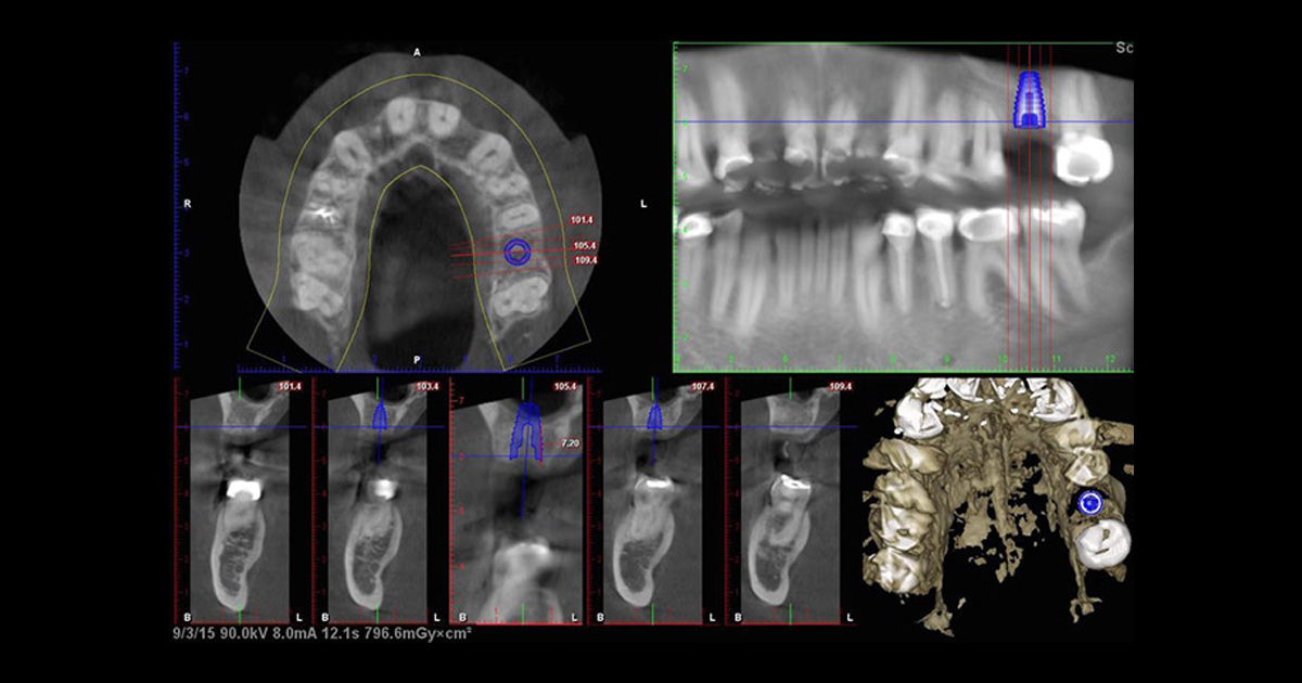 abscessed tooth xray