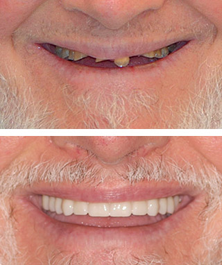 Dental Implants Before and After - Case #2 Dental Implants Before and After - Case #2
