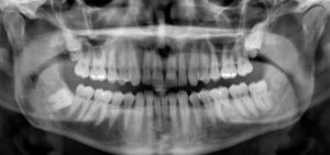 What is a Panoramic X-Ray | Mint Hill Dentistry