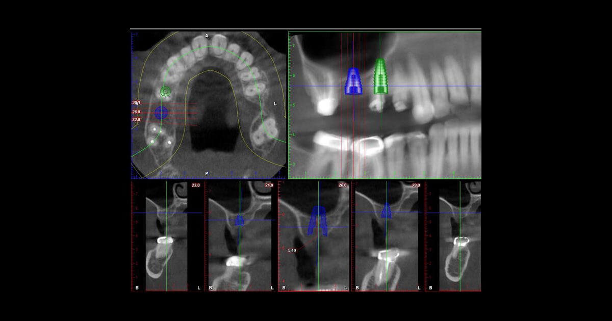 Saving Four Teeth