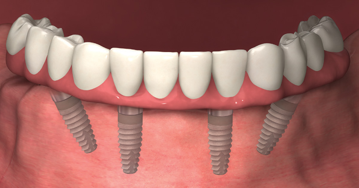 TeethXpress “All on 4” Dental Implants