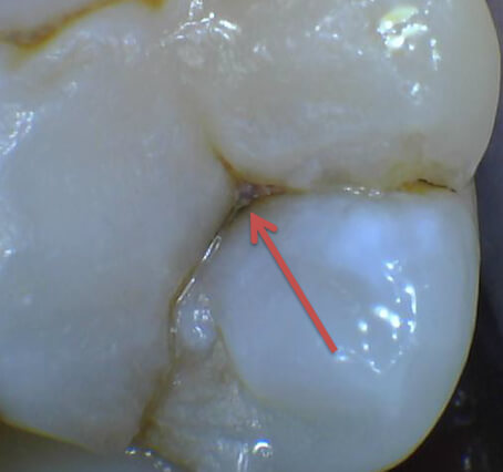 What Does A Tooth Cavity Look Like