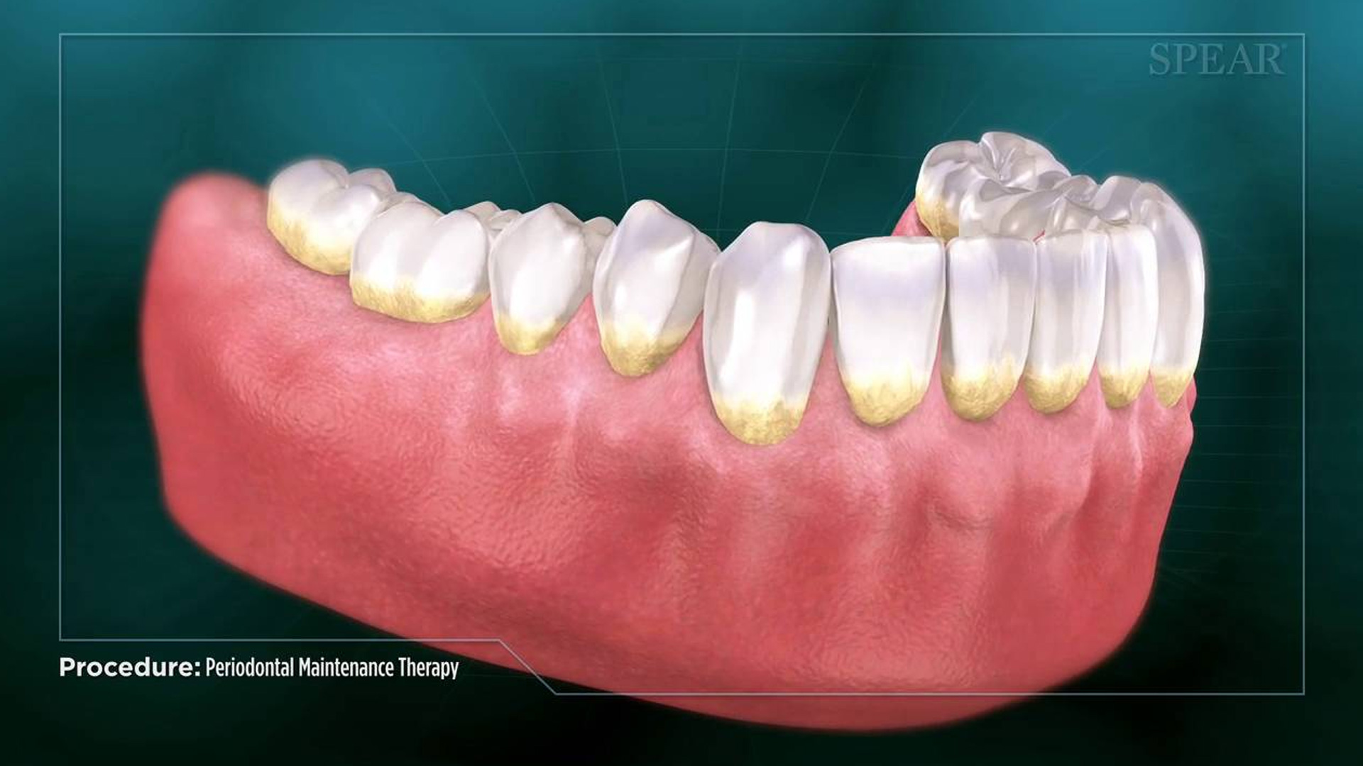 Periodontal Maintenance Therapy Mint Hill Dentistry