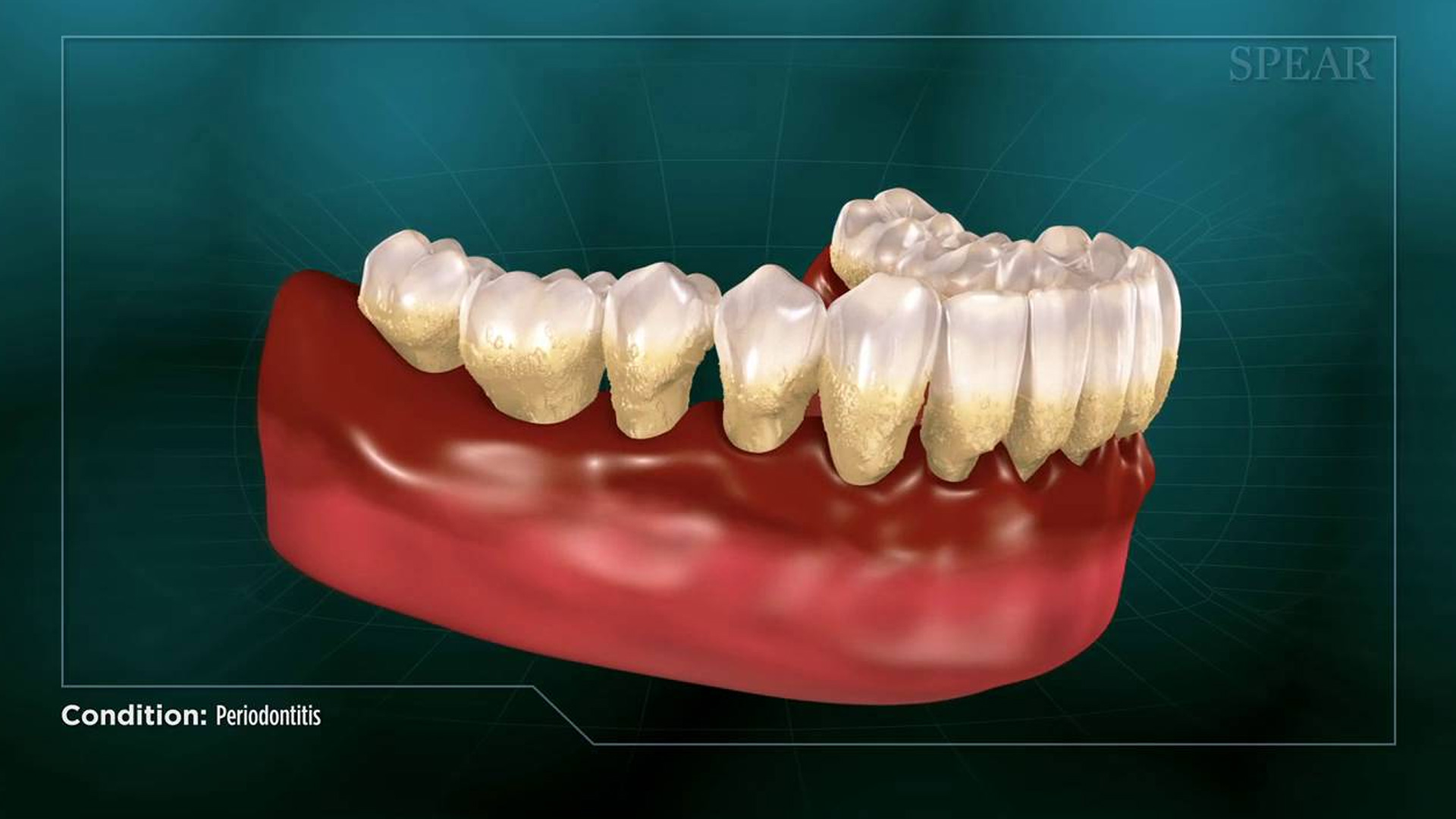 Periodontitis