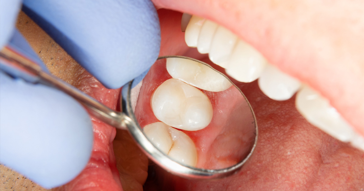 can a root canal be done on a canine tooth