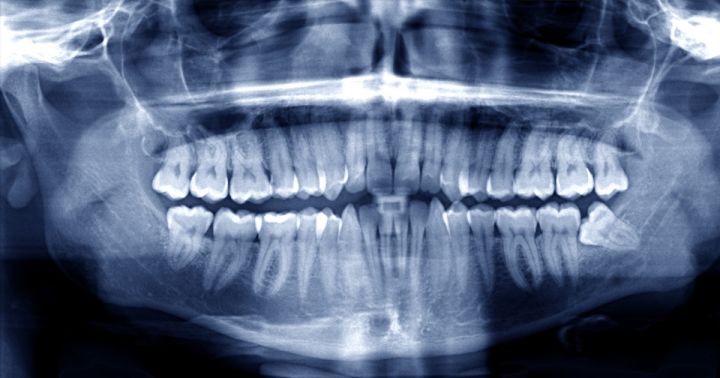 Wisdom Teeth 101 | Mint Hill Dentistry | Charlotte NC Dentist