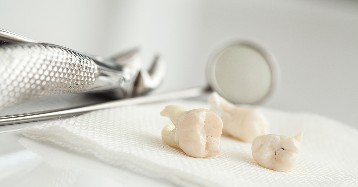 Wisdom Teeth Removal