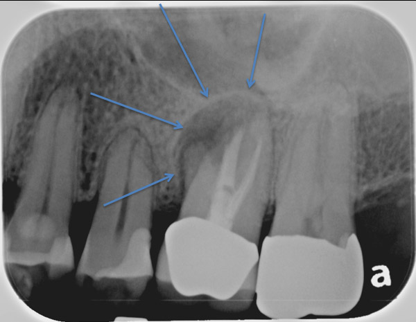 X-ray of painful infected molar tooth | Mint Hill Dentistry | Dentist ...